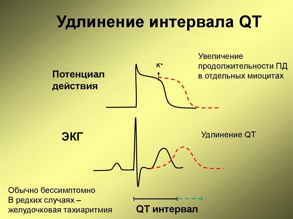 Удлиненное qt на экг. Синдром удлиненного интервала qt на ЭКГ. Удлиненный интервал qt на ЭКГ что это такое. Удлинённый интервал qt на ЭКГ. ЭКГ С синдромом удлиненного интервала qt у детей.