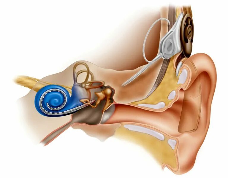 Слуховой аппарат кохлеарный имплант. Аппарат для глухих кохлеарная имплантация. Кохлеарный неврит слухового нерва. Кохлеарный имплант кохлеар. Операция на ухо на слух
