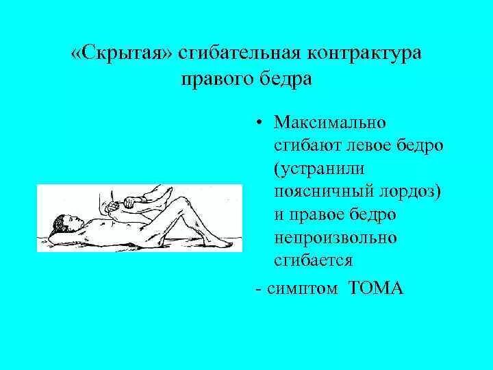 Сгибательная и разгибательная контрактура. Сгибательная приводящая контрактура. Сгибательная контрактура тазобедренного сустава это. Сгибательная контрактов. Сгибательная контрактура сустава