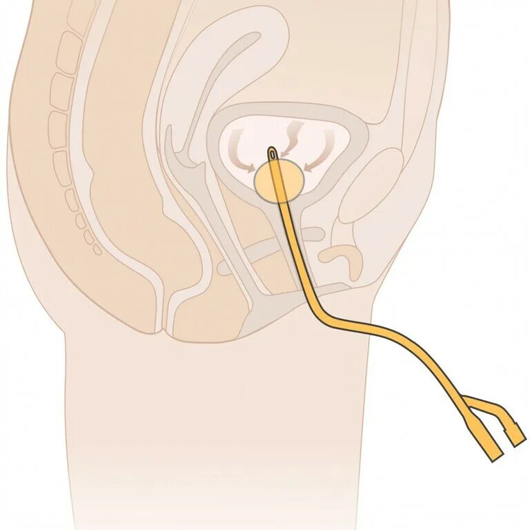 Катетеризация катетером Фолея. Мочеотводной катетер. Уретральный катетер Фолея. Эпицистостома катетер Фолея. Как поставить мочевой катетер