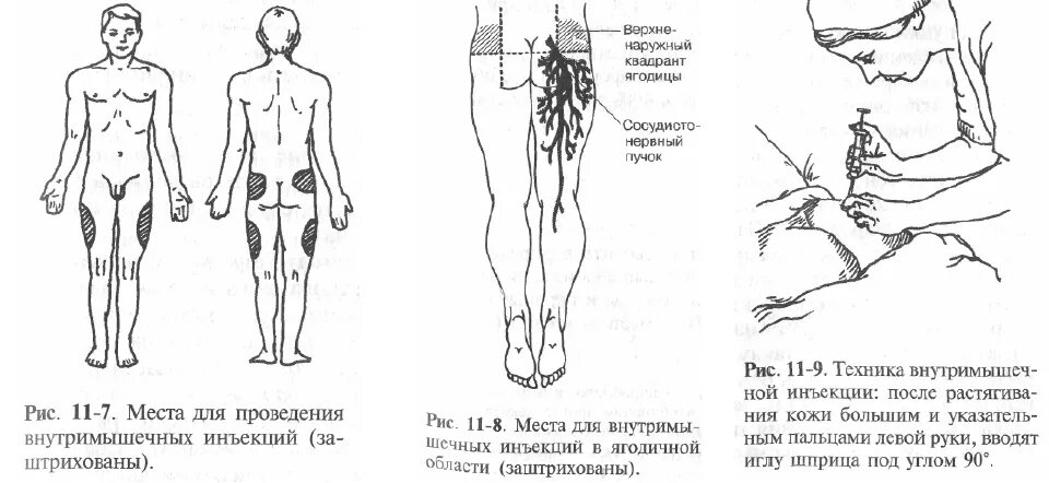 Инъекция в м п к. Внутримышечная инъекция методы введения. Внутримышечное Введение лекарственных средств места. Область введения внутримышечной инъекции. Внутримышечная инъекция места введения лекарственных средств.