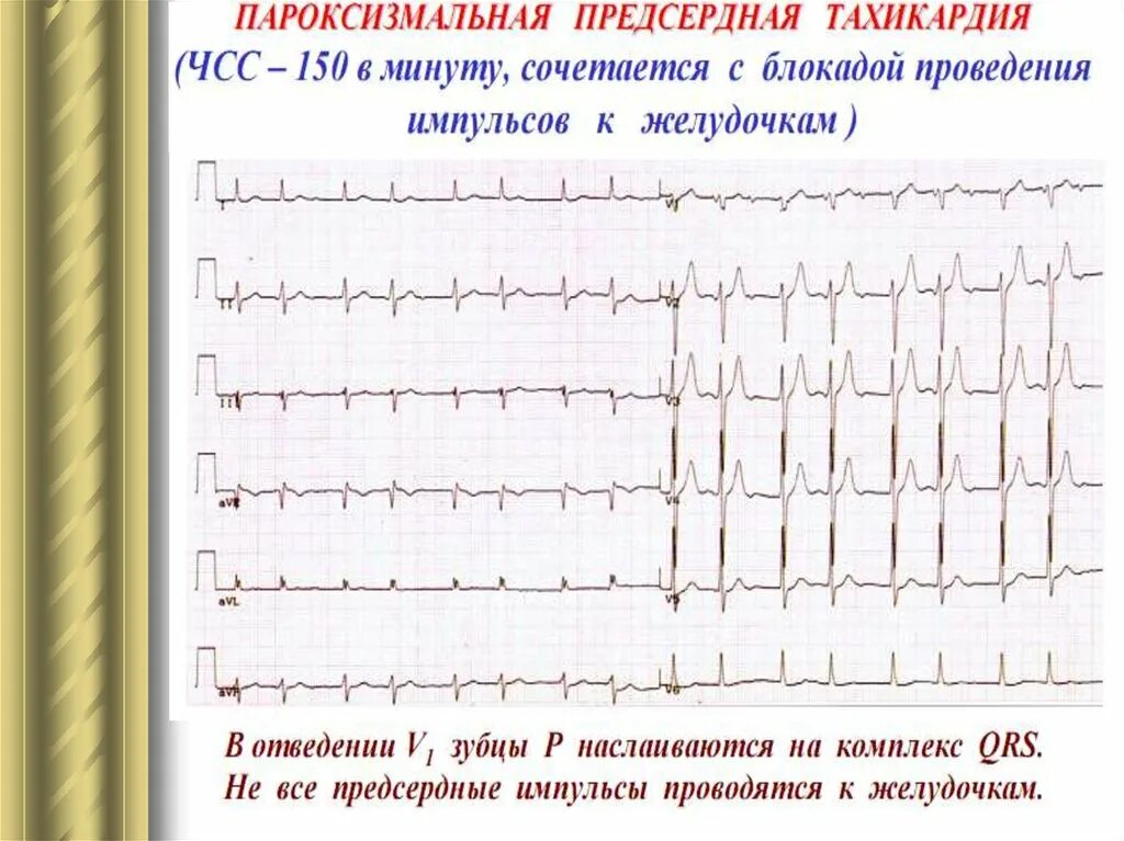 Какие анализы при тахикардии. Предсердная пароксизмальная тахикардия на экг. тахикардия предсердий на экг. ритм при пароксизмальной тахикардии. многофокусная предсердная тахикардия на экг.