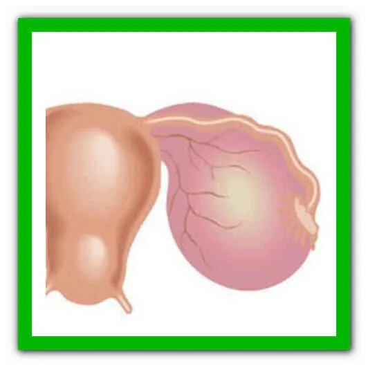 Кист яичка народными средствами. Киста яичника народные средства. Киста яичника уже 20 лет. Народные средства при кисте яичника.