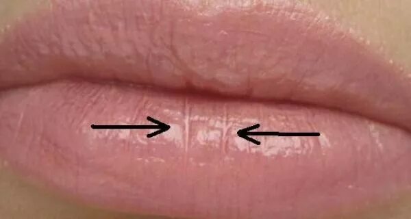 красная полоска на губах. красная полоска на губах. красная полоска на губах. эксфолиативный хейлит. фордайс гранулы фордайса.