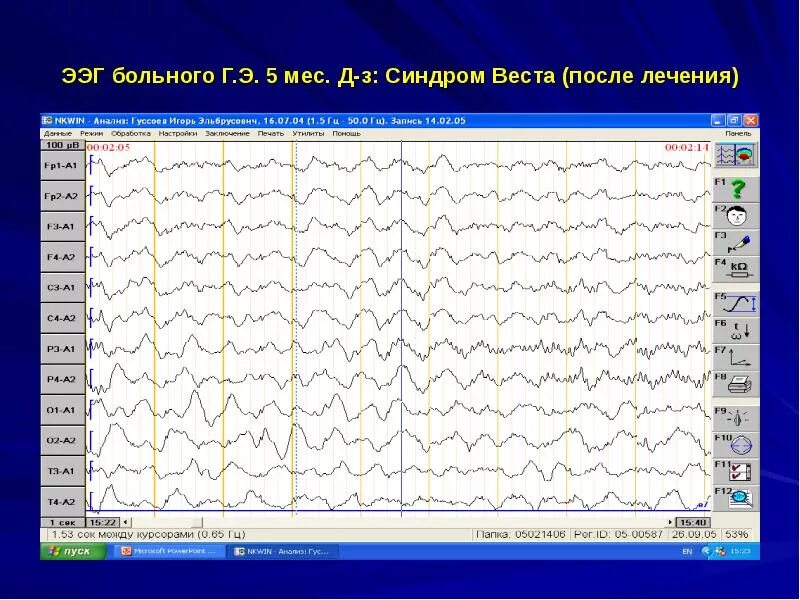 Гипсаритмия на ЭЭГ.