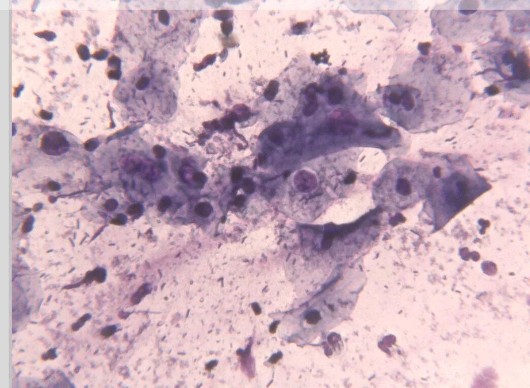 промежуточно клеточный тип мазка цитология. цитология эстрогенный тип. тип цитологического влагалищного мазка. цитология эстрогенный тип.