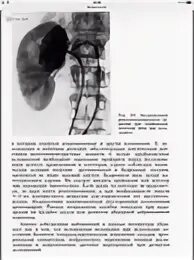 ОГК рентген почек труб. Темное пятно на рентгене почек. На рентгенограмме одна почка. Немая почка рентгенограмма. Горбатая почка