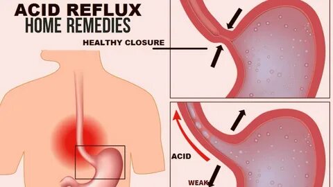 Can Acid Reflux Cause Chest Pain.