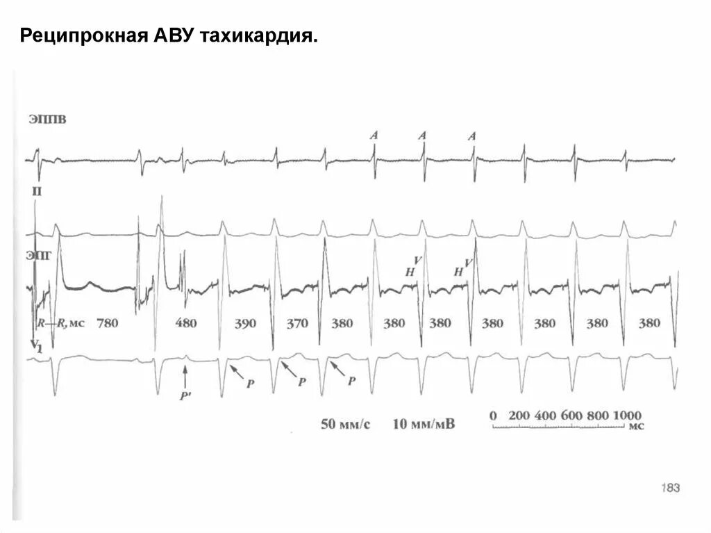 Пробежки наджелудочковой тахикардии. Суправентрикулярная экстрасистолия на экг. Зубец р после qrs комплекса. Суправентрикулярный ритм на экг. Эпизод суправентрикулярной тахикардии.