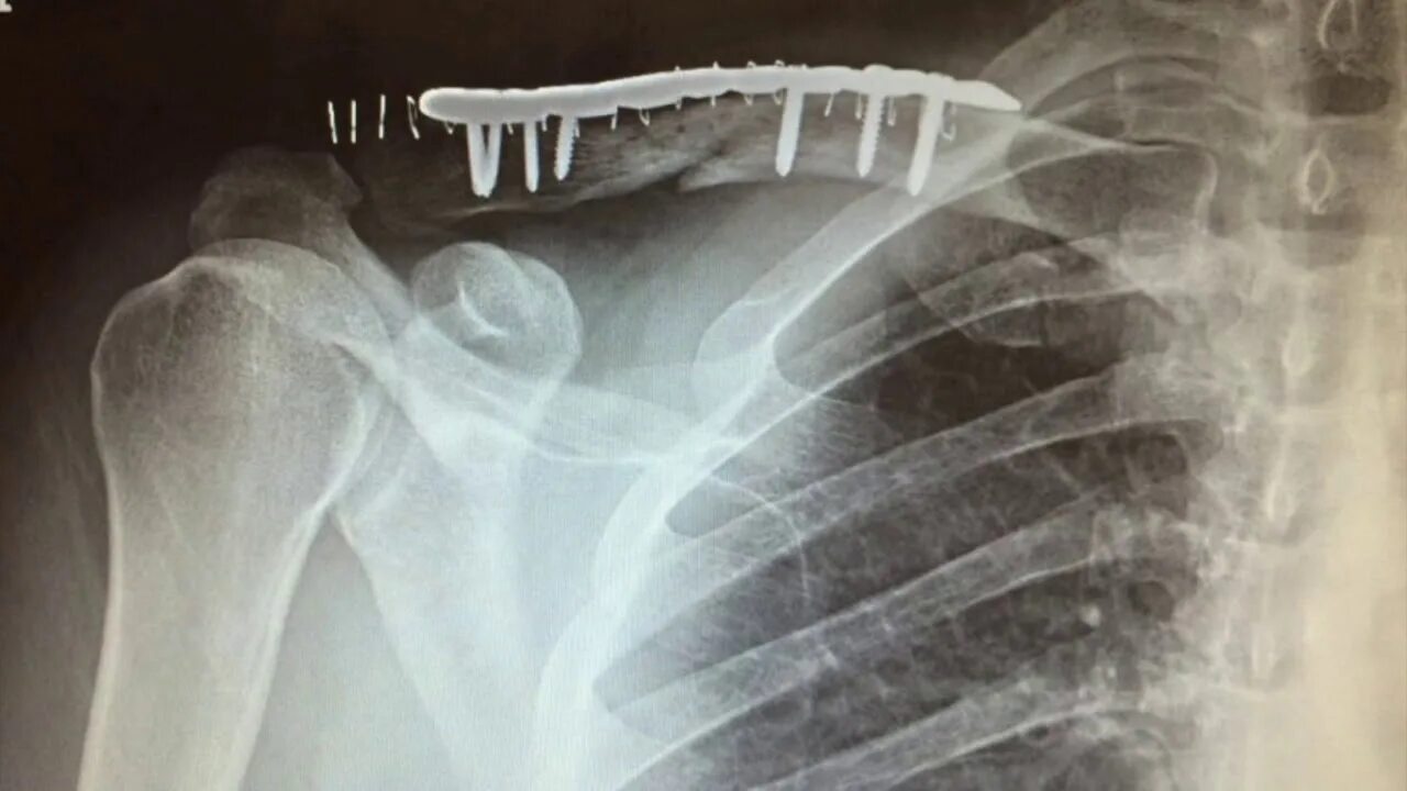 Хондрома грудино ключичного сочленения. Fractured collarbone. Clavicle. Fractures of the collarbone classification. Перелом ключицы со смещением.