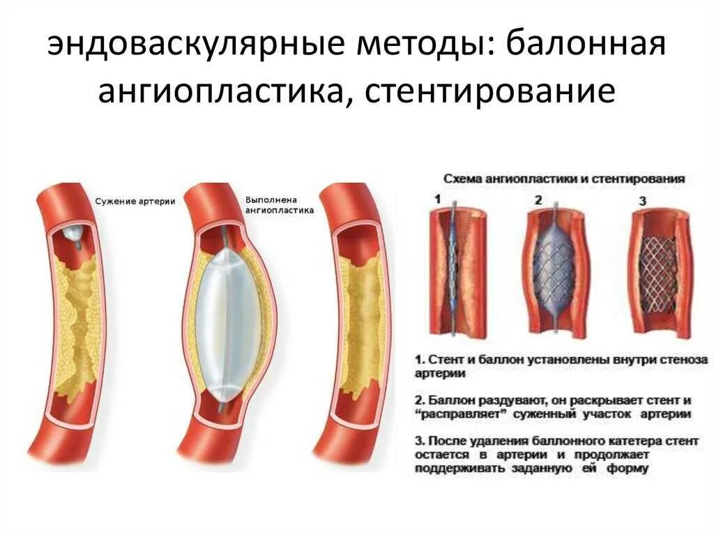 Баллонная ангиопластика и стентирование артерий сердца. Эндоваскулярная баллонная ангиопластика. Рентген эндоваскулярная баллонная ангиопластика. Стентирование сосудов эндоваскулярное. Ангиопластика цена