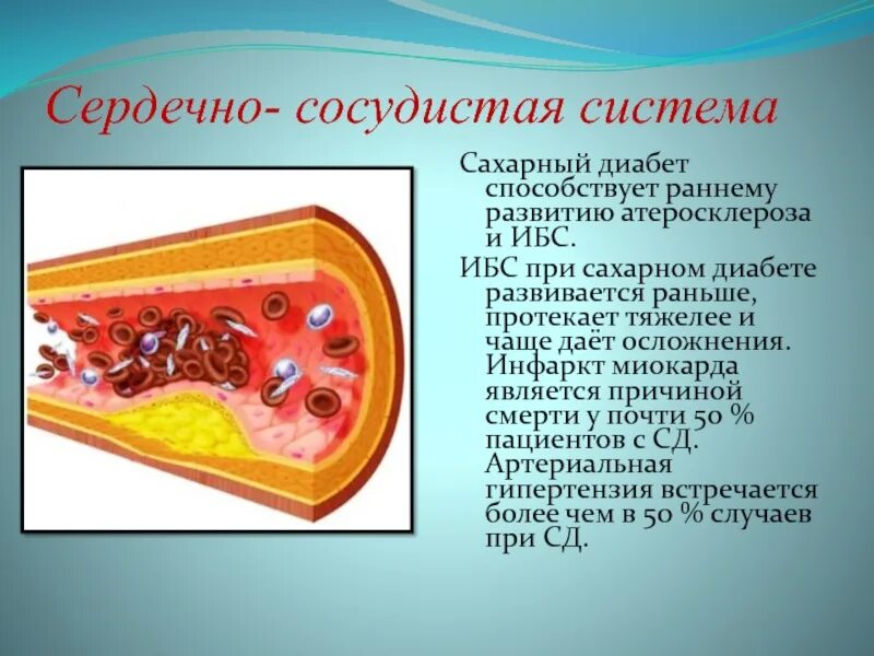 Диабетический атеросклероз. Ибс при сахарном диабете. развитию атеросклероза и ибс способствуют. атеросклероз при сахарном диабете.