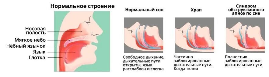 Почему появляется храп. Причины храпа. Строение носоглотки храп.