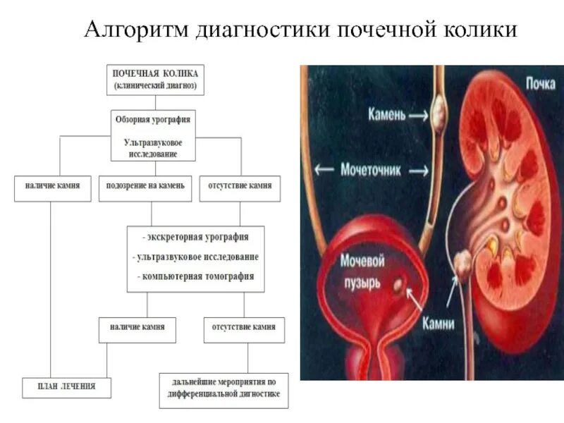 Алгоритм лучевой диагностики при почечной колике. План обследования при почечной колике. Почечная колика диагностический алгоритм. Почечная колика лабораторные показатели. Почечная колика симптомы первая