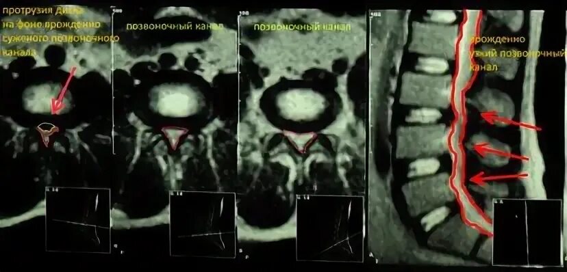 Остеохондроз поясничного отдела l5 s1. Сакрализация l5 позвонка на мрт. Сакрализация l5 позвонка рентген. Спондилоартроз фасеточных суставов. Дугоотросчатые суставы позвоночника на мрт.