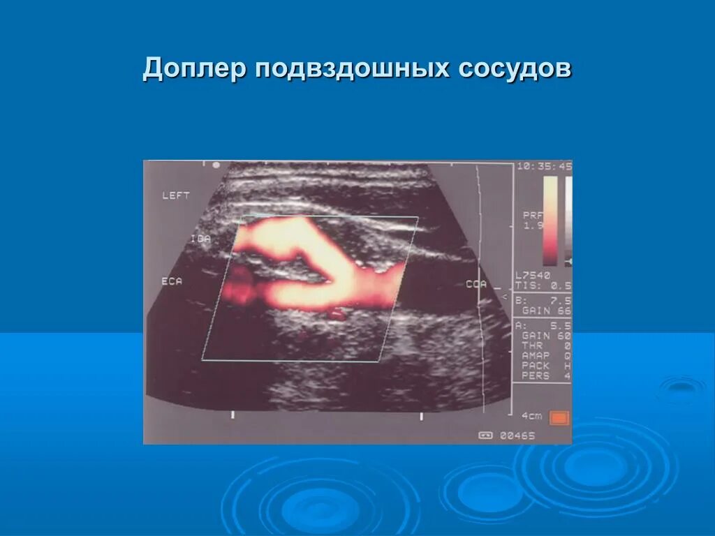 Доплер артерий. Метод Доплера. Доплер УЗИ Ветеринария. УЗИ В урологии презентация.