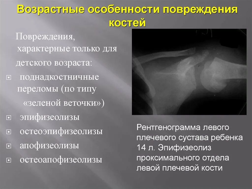 Разрыв кости. Эпифизеолиз левой плечевой кости. Травматический эпифизеолиз плечевой кости. Характерное повреждение костей у детей. Апофезеолис плечевой кости.