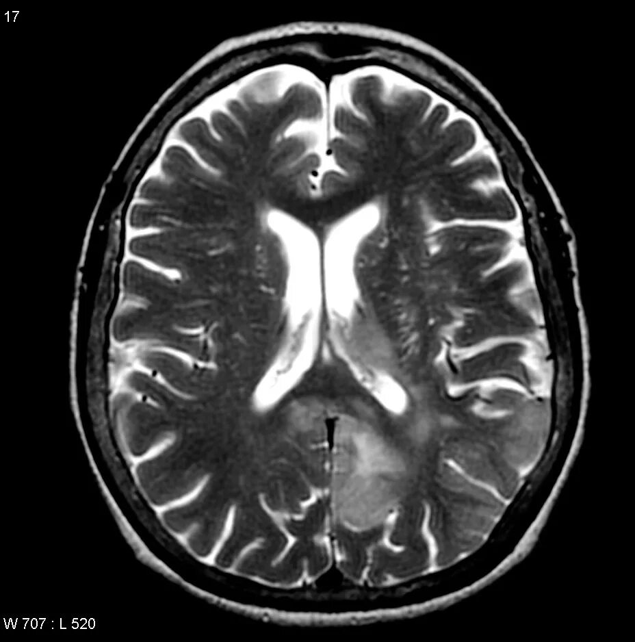 Диффузная церебральная. Глиоматоз на мрт. Глиоматоз головного мозга. Глиоматоз мозга на кт. Глиоматоз головного мозга мрт.