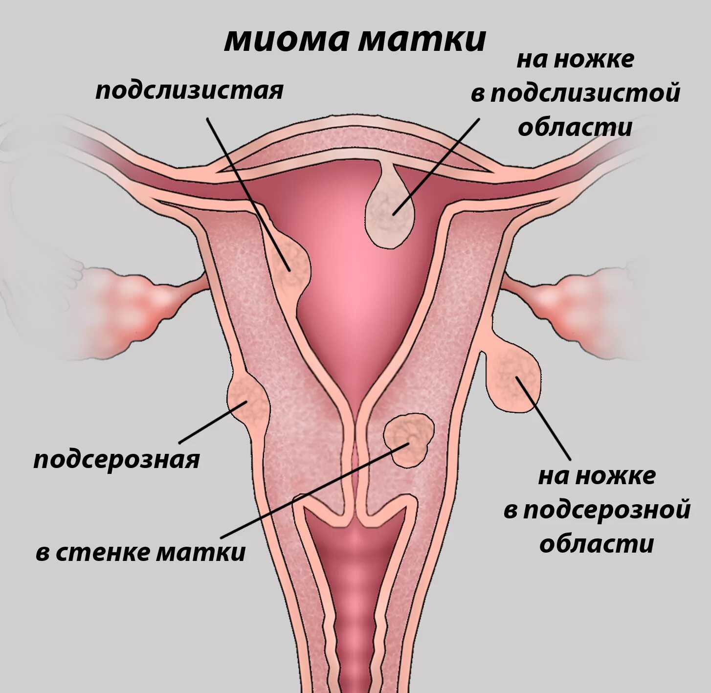 Удаление стенки матки