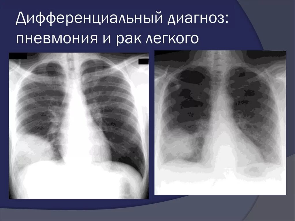 Пневмония на рентгене. Рентген диагностика пневмонии.