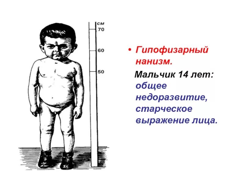 Карликовость функции. Заболевания гипофиза карликовость. гипокортикоидная карликовость. гипофизарный карликовый нанизм. гипофизарный нанизм клиническая картина.