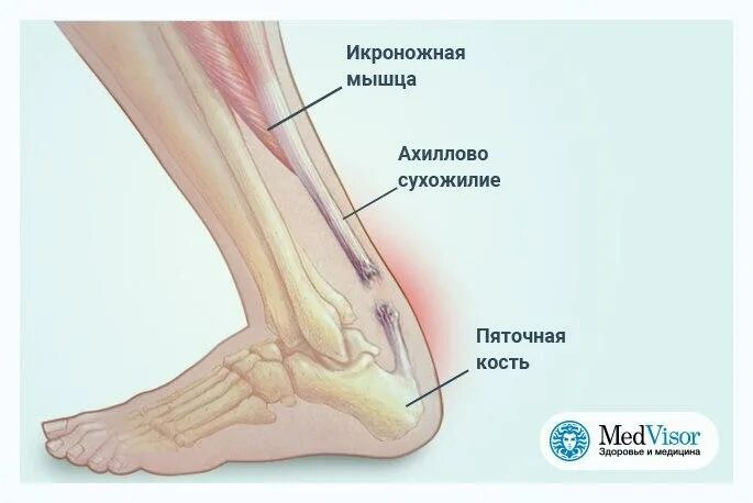 Выше пятки как называется