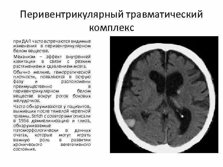 Перивентрикулярный очаг головного мозга. Перивентрикулярные очаги головного. Перивентрикулярная лейкомаляция кт. Перивентрикулярная белое вещество головного мозга. Поражение белого вещества мозга