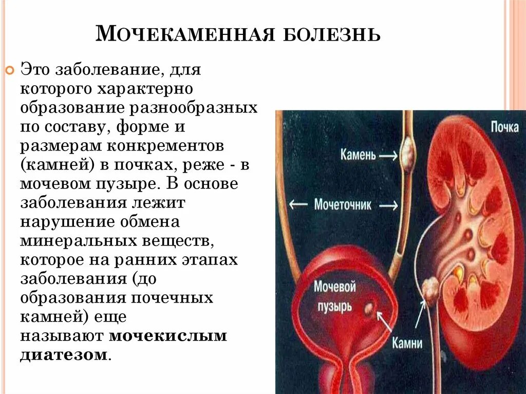 Заболевания мочевыделительной системы мочекаменная болезнь. Камни в мочевом пузыре патанатомия. Болезни мочевыделительной системы мочевой пузырь. Мочекаменная болезнь - патоморфология. Распад почки