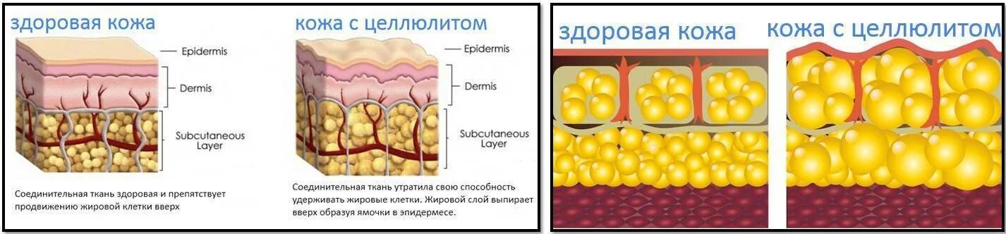 Подкожно жировая клетчатка у женщин. Целлюлит строение жировой ткани. строение кожи целлюлит. строение жировой клетки, жировой ткани. строение жировой ткани у мужчин и женщин.
