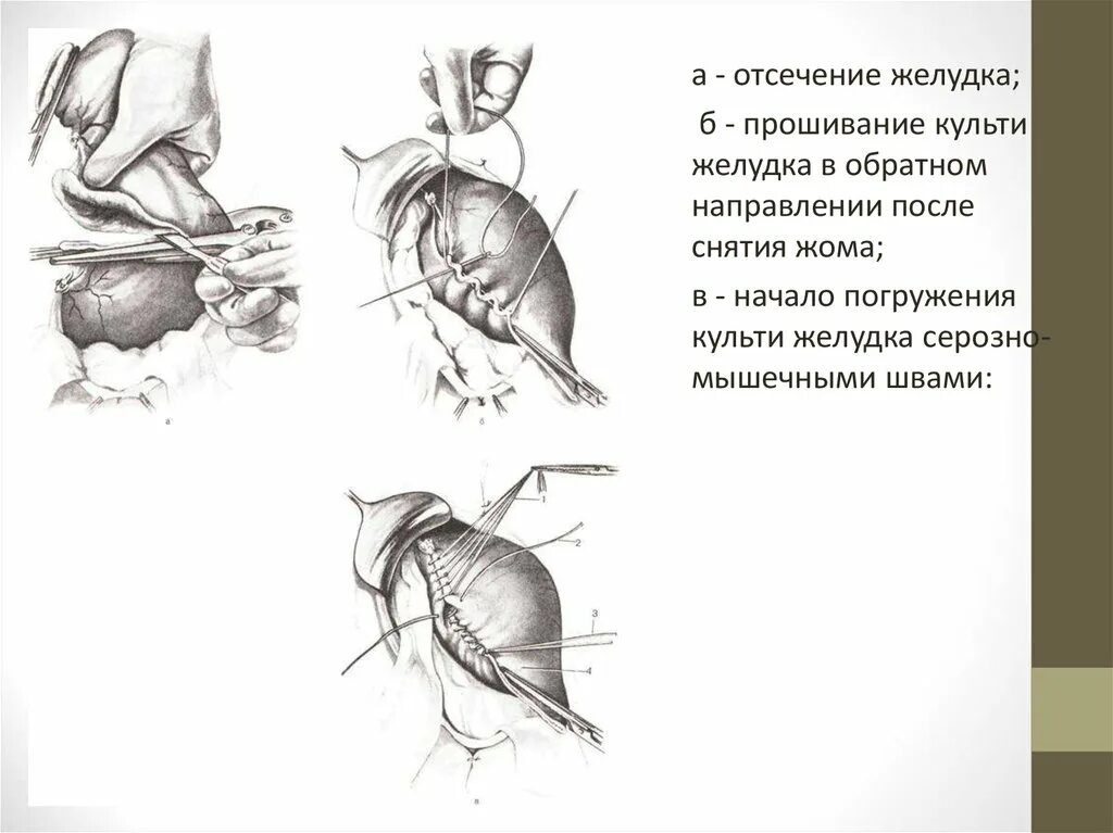 Операция Бильрот 1 схема операции. Культя желудка после резекции. Без желудка после операции