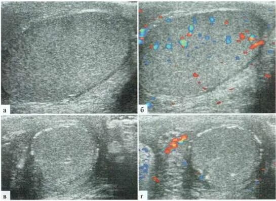 Увеличено яичко у мальчика. Гипоплазия придатка яичка. Перекрут яичка УЗИ картина.