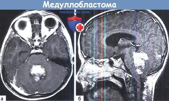 Медуллобластома это. Медуллобластома мозжечка мрт.