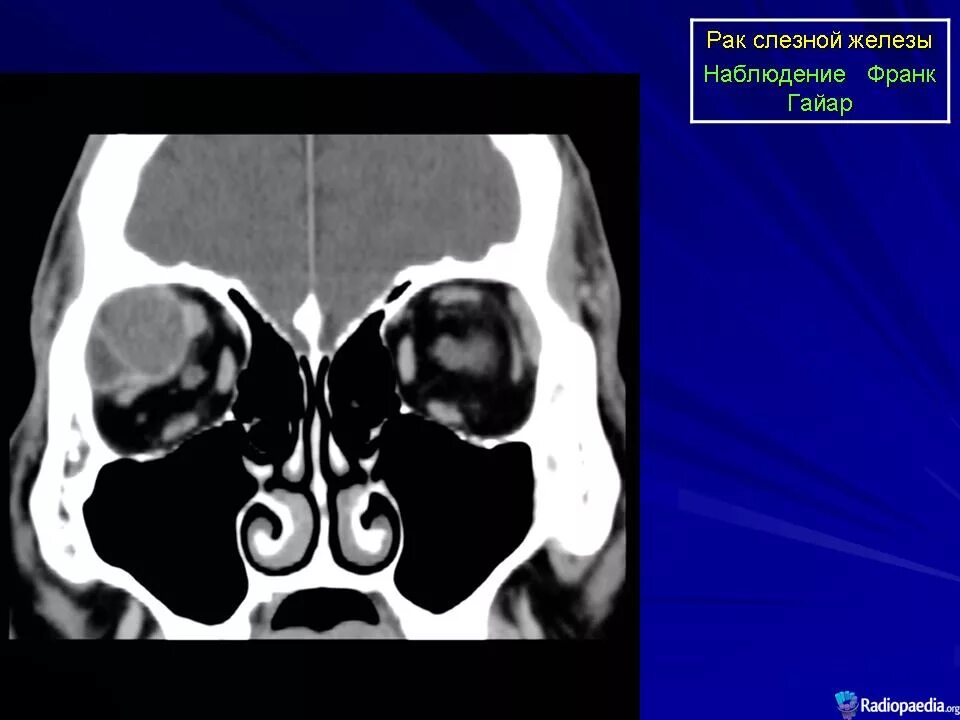Лечение слезной железы. Слезная железа мрт анатомия. Аденокарцинома слезной железы. Воспаление слезной железы на кт. Опухание слезной железы.