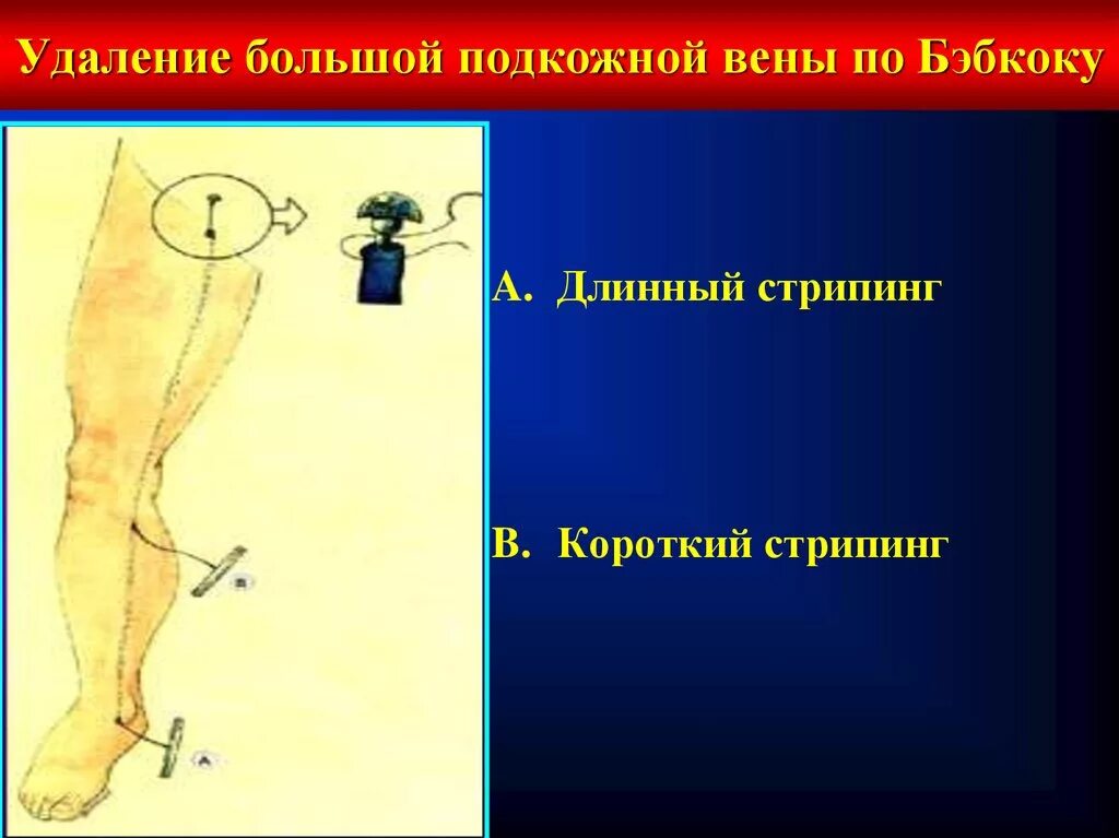 Удаление большой подкожной. Стриппинг малой подкожной вены. Флебэктомия подкожных вен. Удаление большой подкожной. Стриппинг малой подкожной вены.