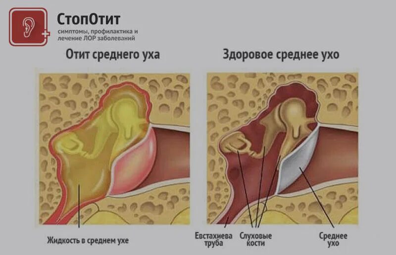 Острый диффузный наружный отит. Гной экссудативный отит. Острый катаральный средний отит. Отит эффективное лечение