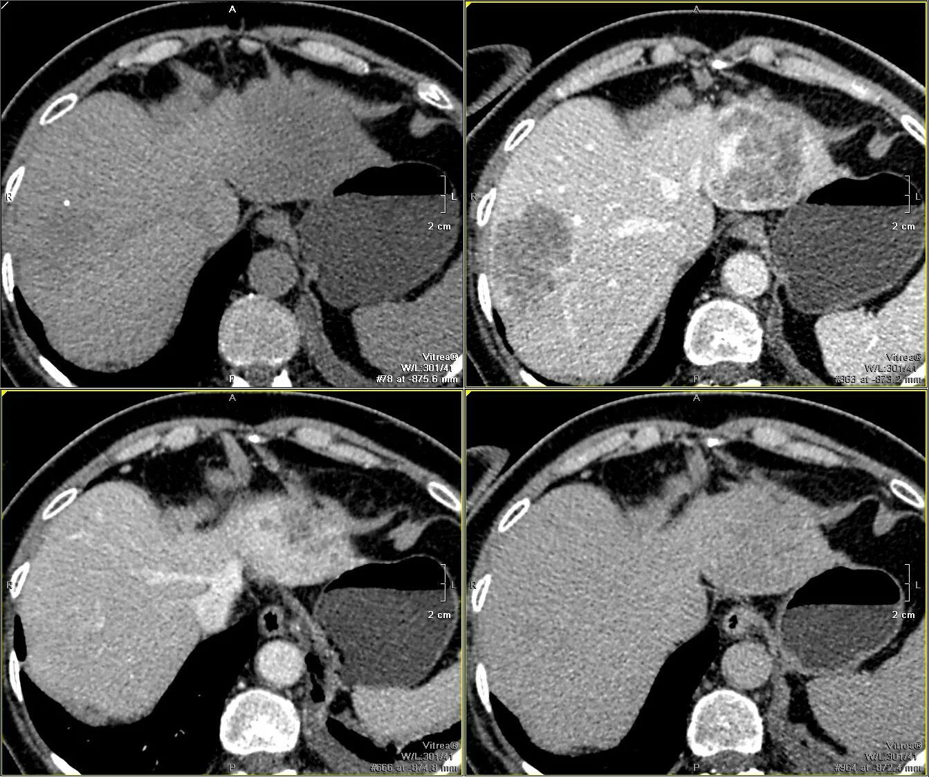 кт печени форум. магнитно-резонансная томография печени. схема печени кт. альвеолярный эхинококкоз печени кт. кавернозная гемангиома печени мрт.