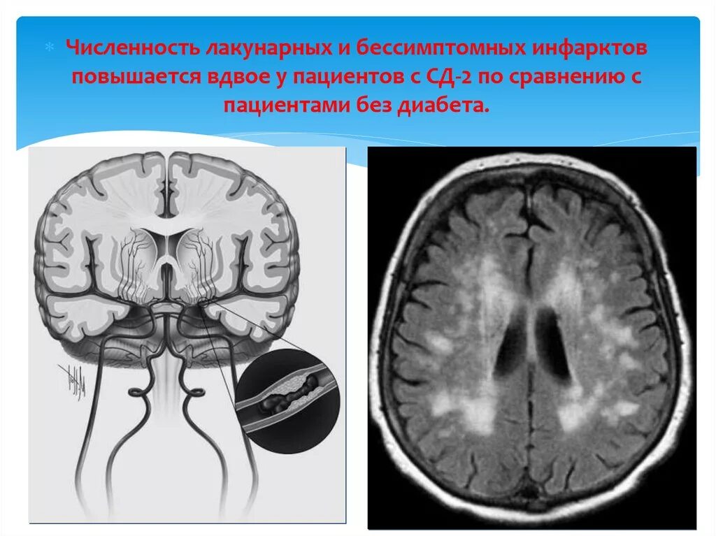 Инфаркт мозга неуточненный. Лакунарный ишемический инсульт мрт. Лакунарный инфаркт головного мозга кт. Лакунарный ишемический инсульт кт. Ишемические лакунарные очаги.