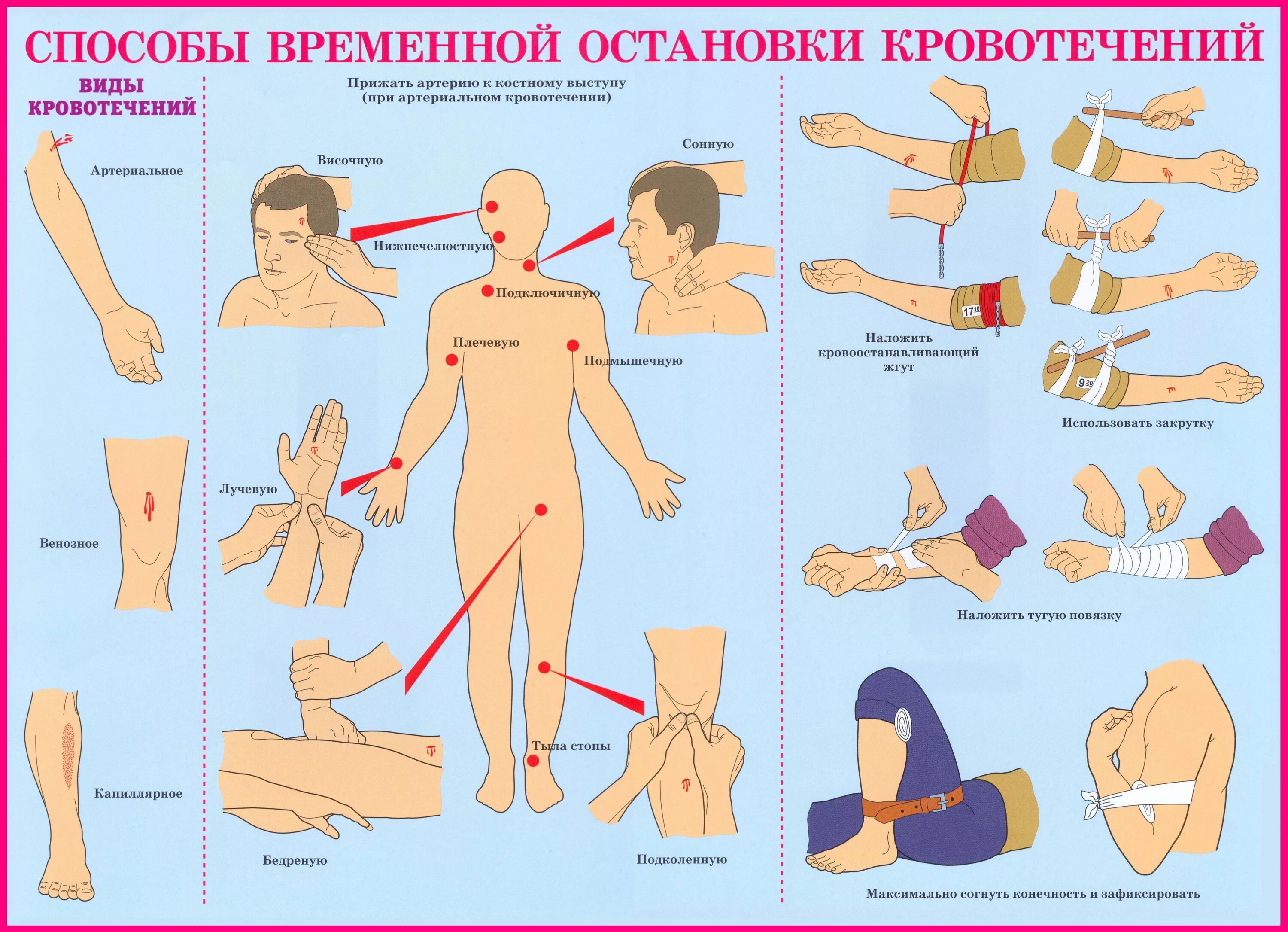 Пути остановки кровотечений. Способы остановки кровотечения артериального артерии. Временные способы остановки кровотечения. Методы временного остановки кровотечения. Укажите способы временной остановки кровотечения.