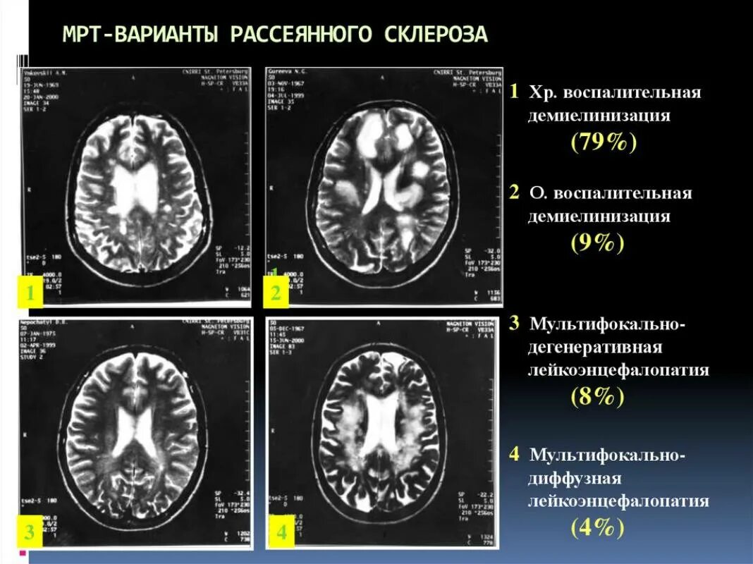 Мрт симптомы. Мрт очаги поражения рассеянный склероз. пальцы доусона при рассеянном склерозе на мрт. мрт рассеянный склероз планинг. картина рассеянного склероза на мрт.