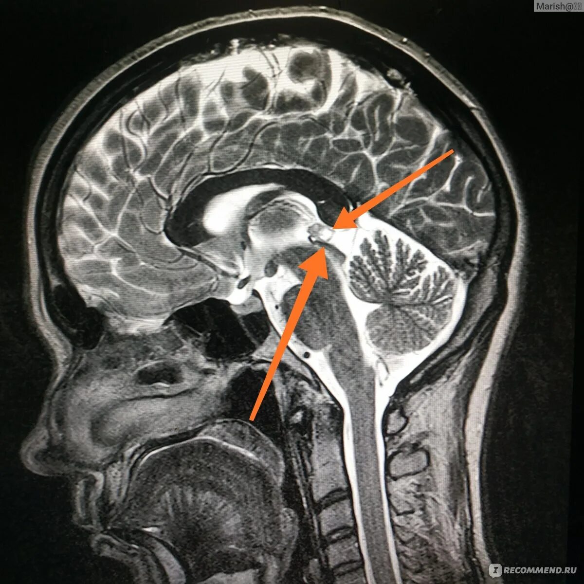 Киста мозга рассосалась. Киста эпифиза в головном мозге. Киста шишковидной железы головного мозга мрт.