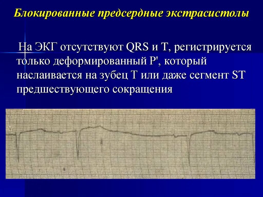 Блокированная желудочковая экстрасистолия. Блокированная желудочковая экстрасистолия на ЭКГ. Блокированная наджелудочковая экстрасистолия на ЭКГ. Блокированная предсердная экстрасистолия на ЭКГ. Блокированные экстрасистолы