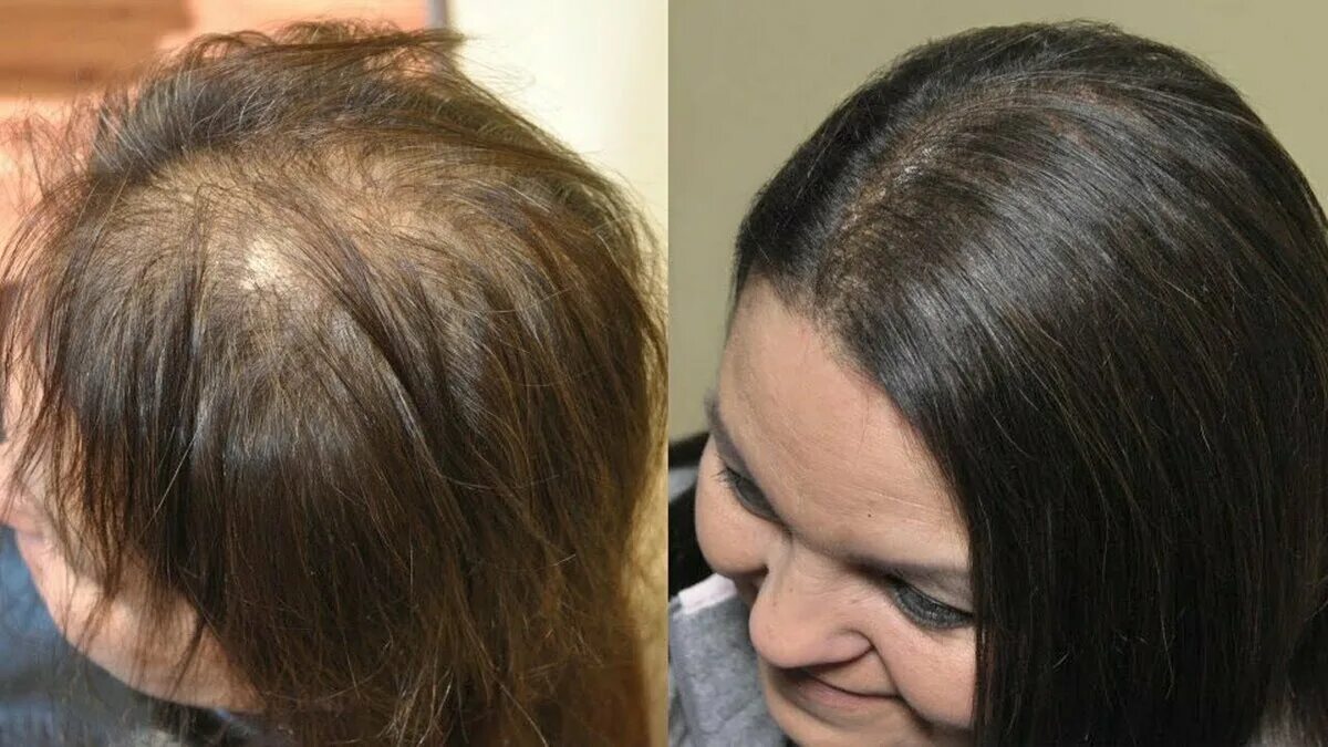 Выпадение волос алопеция. Алопеция у женщин лечение отзывы