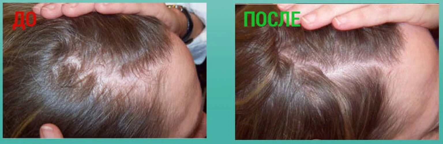 Отчего на голове не растут. Подшерсток новых волос. подшерсток новых волос на голове. растет подшерсток на голове.