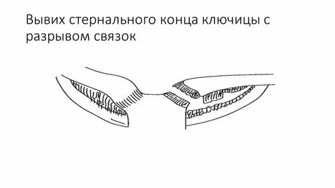 Вывих конца ключицы