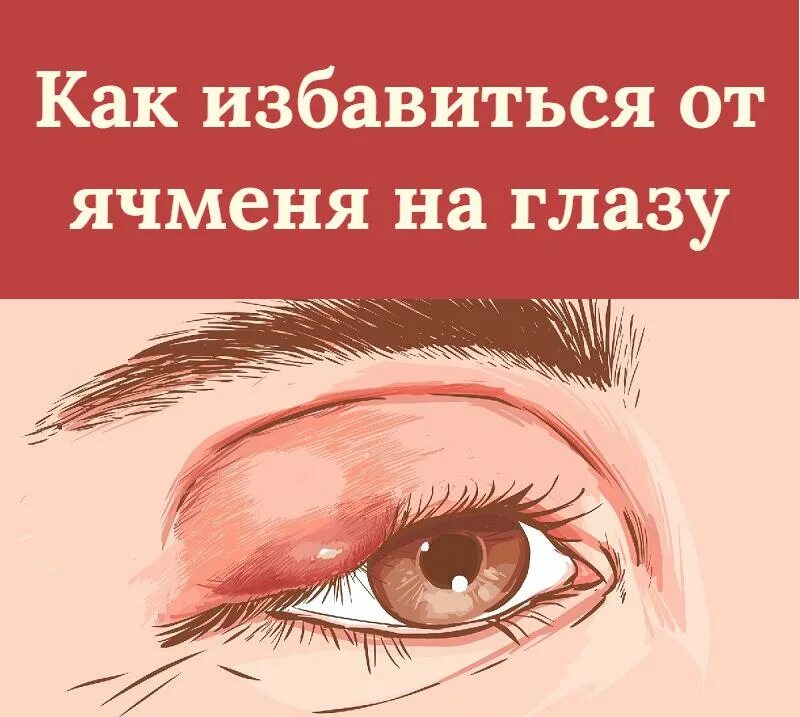 Народное лечение ячменя