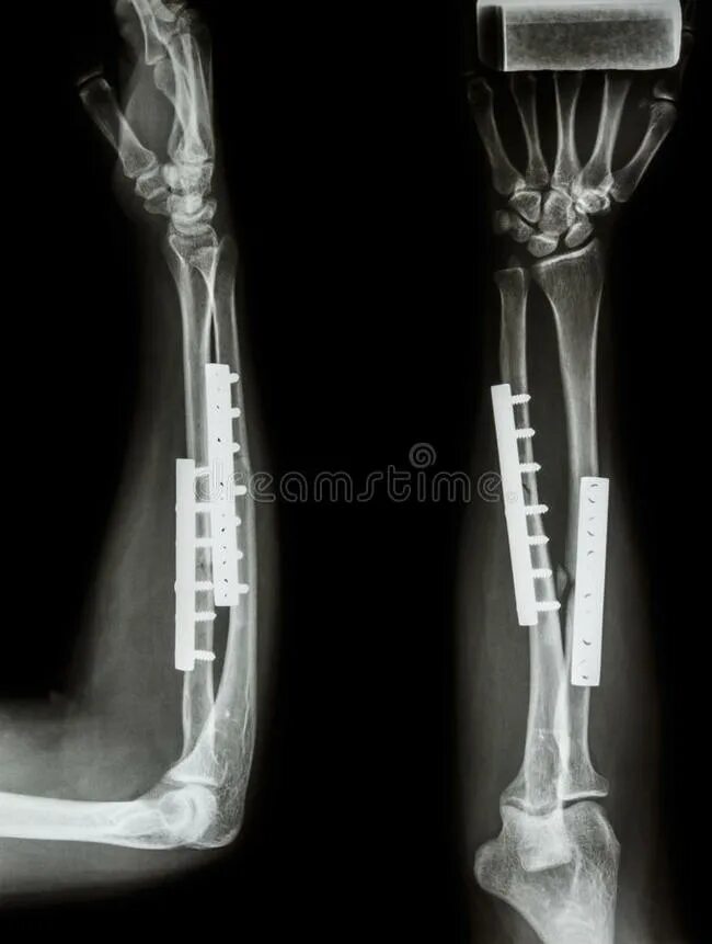 перелом локтевого отростка металлоостеосинтез. остеосинтез локтевой кости. перелом локтевого остеосинтез. остеосинтез локтевого отростка по веберу рентген. перелом локтевого отростка остеосинтез рентген.