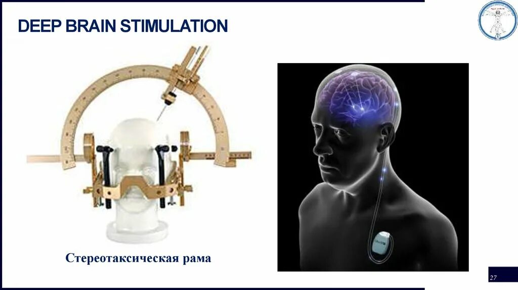 Deep brain. Стереотаксическая рама. Стереотаксическая нейрохирургия. Стереотаксическая методика.