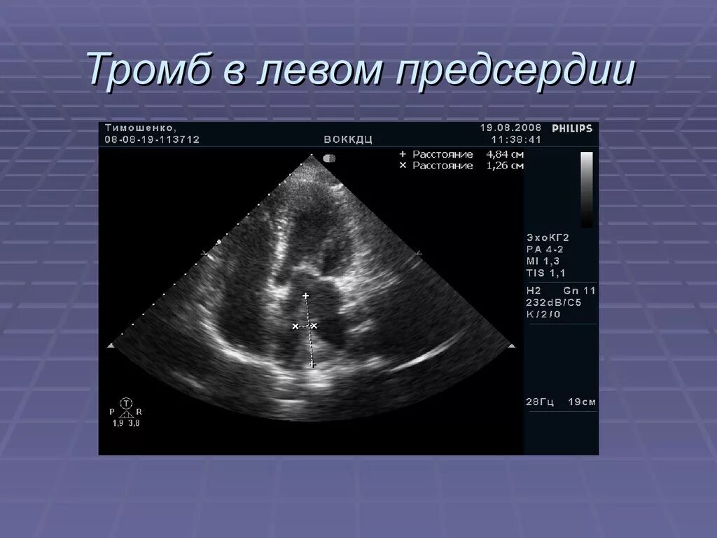 Образование левого предсердия. Тромб в левом предсердии ЭХОКГ. Тромб правого предсердия Эхо. Ушко левого предсердия ЭХОКГ.