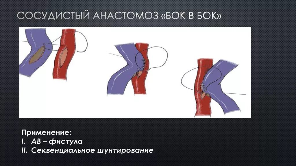 Что такое анастомоз. Сосудистый анастомоз бок в бок. сосудистый анастомоз конец в бок. сосудистый шов конец в бок.