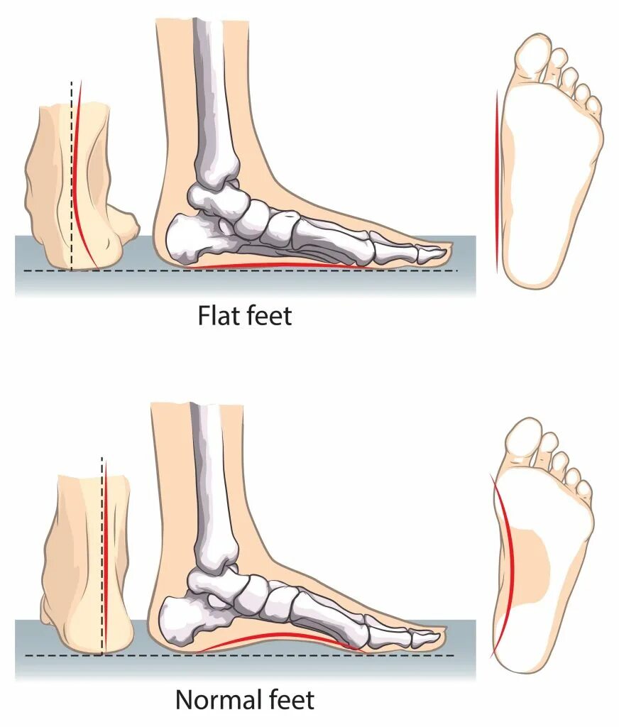 Normal feet